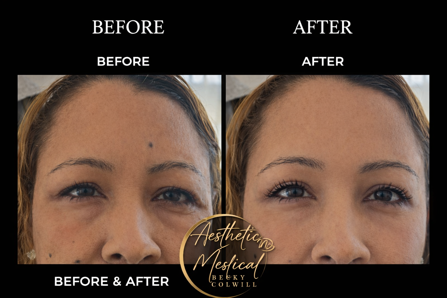 Before and after — Eye & Brow Lift