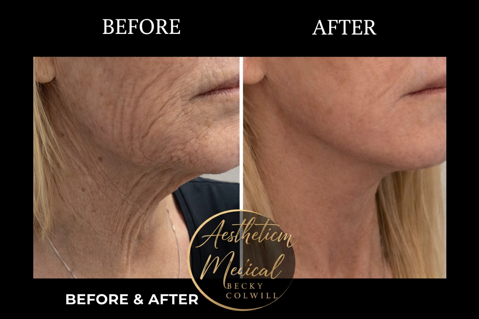 Before and after — Neck Definition