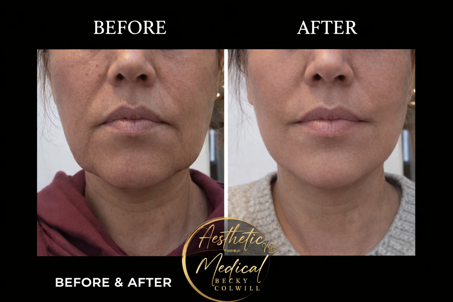 Before and after — Skin Tightening