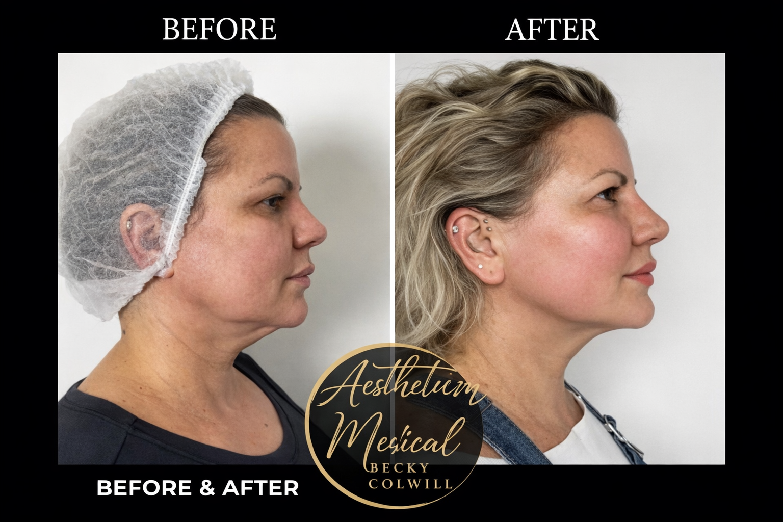 Before and after — Jawline & Jowls